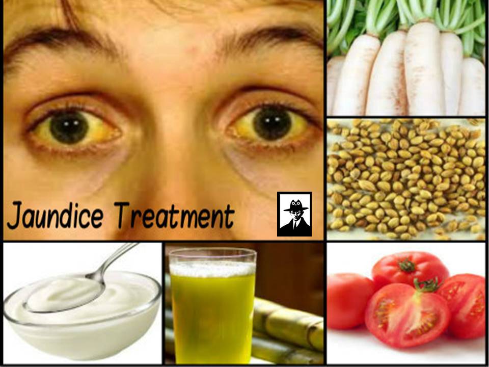 வெயில் மட்டுமல்ல.. மஞ்சள் காமாலை நோயும் கிளம்பிட்டுய்யா! – அலெர்ட் ரிப்போர்ட்