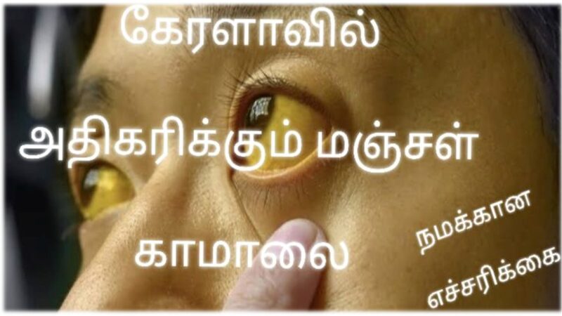 கேரளாவில் அதிகரிக்கும் “மஞ்சள் காமாலை”: நமக்கான எச்சரிக்கை!