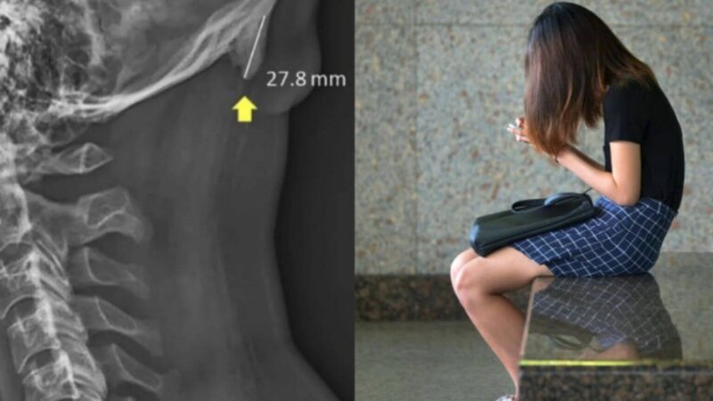 செல்போன் பயன்பாட்டால் மண்டையோட்டில் முளைவிடும் ஒரு ‘புதிய எலும்பு’!